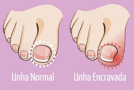 Tem Unhas Encravadas? Esse post é para você. - Polideia